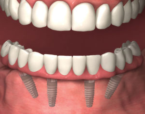 DENTALSource of California all-on-4 implants
