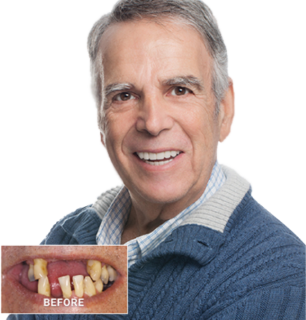 DENTALSource of California all-on-4 implants